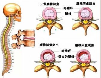 腰椎间盘突出