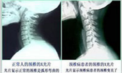 颈椎病治疗的方法